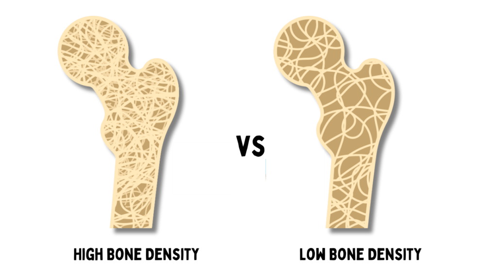 bone density visual